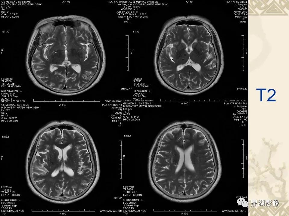 【PPT】SWI（磁敏感加权成像）在中枢神经系统疾病的应用