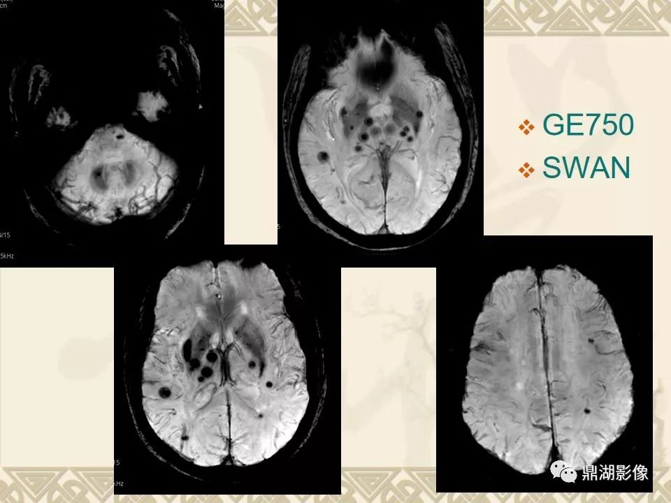 【PPT】SWI（磁敏感加权成像）在中枢神经系统疾病的应用