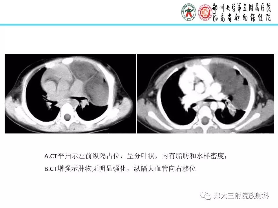 【病例】儿童颈部脂肪母细胞瘤影像诊断