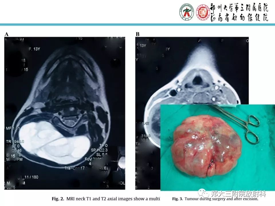 【病例】儿童颈部脂肪母细胞瘤影像诊断