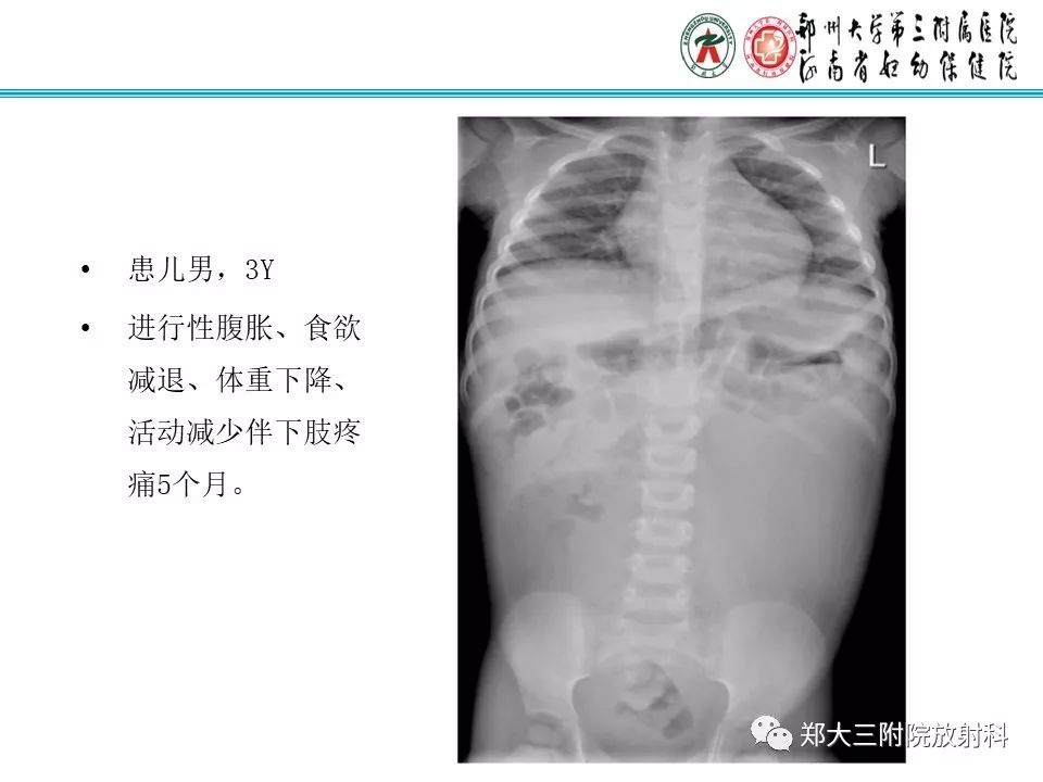 【病例】儿童颈部脂肪母细胞瘤影像诊断