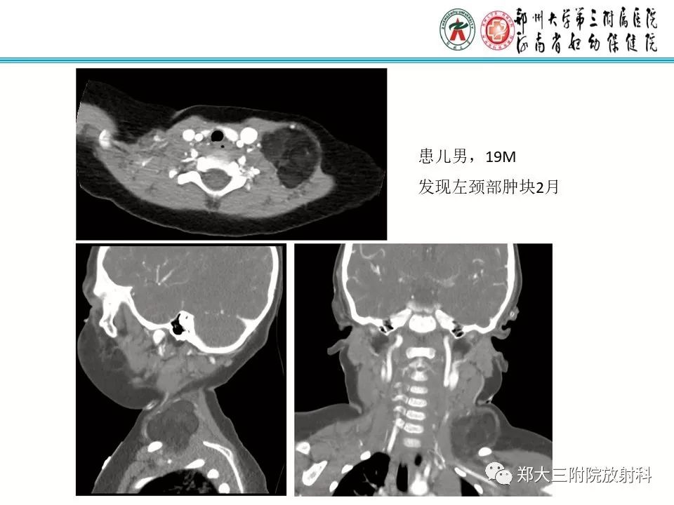 【病例】儿童颈部脂肪母细胞瘤影像诊断