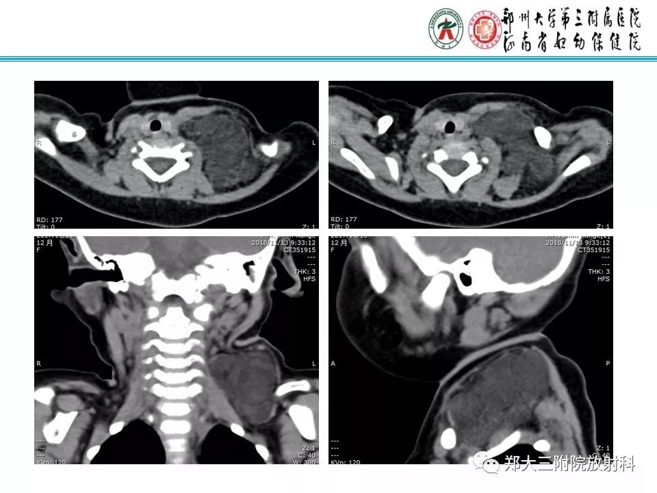 【病例】儿童颈部脂肪母细胞瘤影像诊断