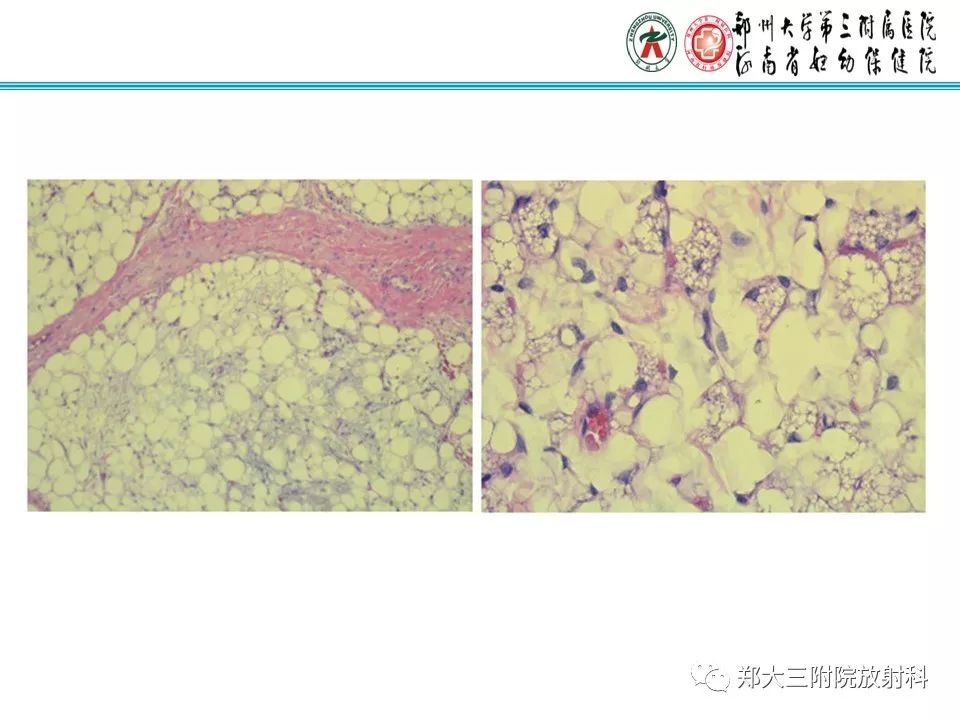 【病例】儿童颈部脂肪母细胞瘤影像诊断