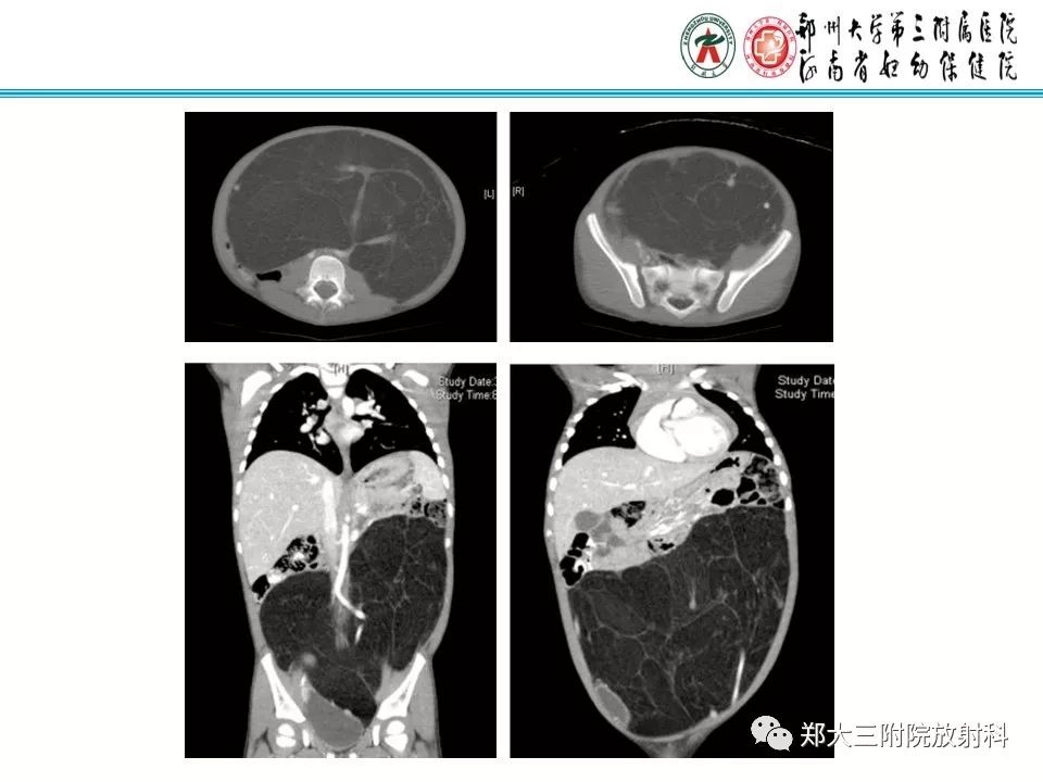 【病例】儿童颈部脂肪母细胞瘤影像诊断