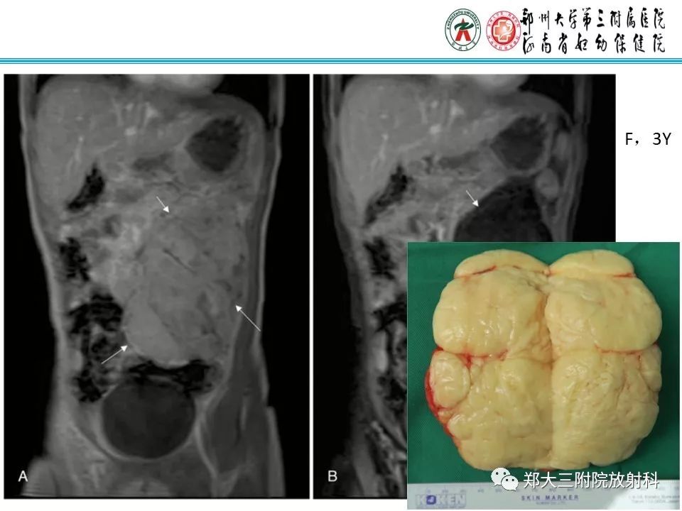 【病例】儿童颈部脂肪母细胞瘤影像诊断
