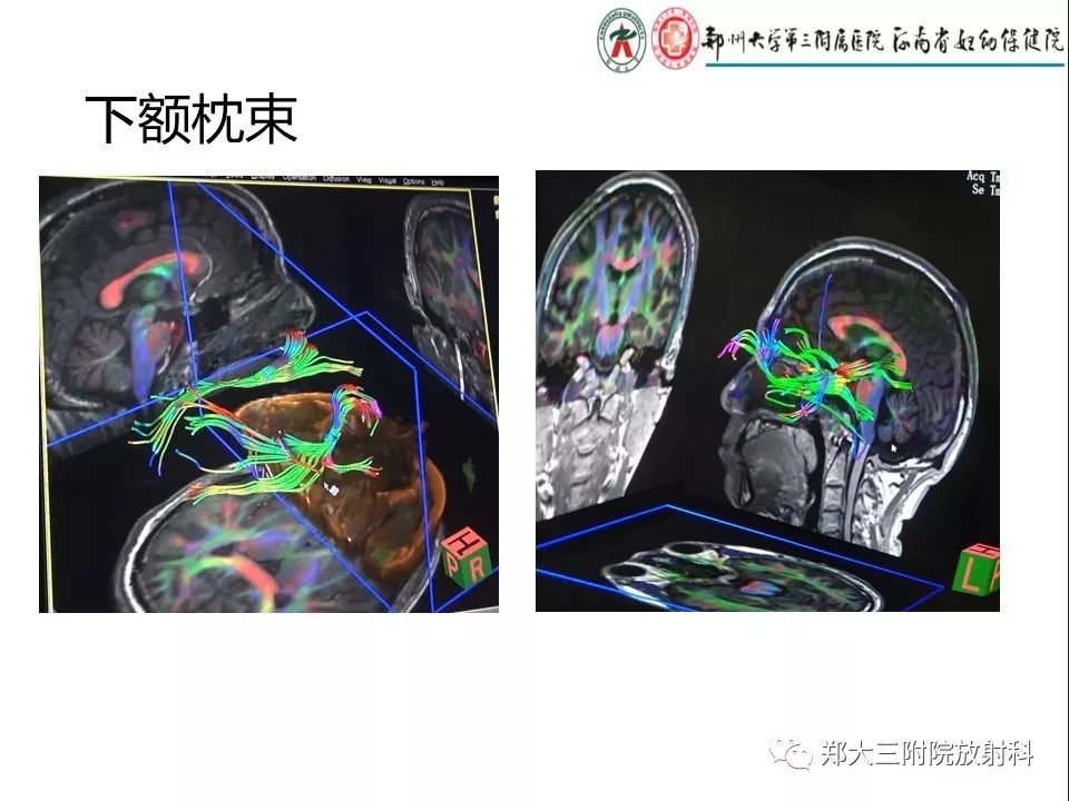 【PPT】DTI常规处理