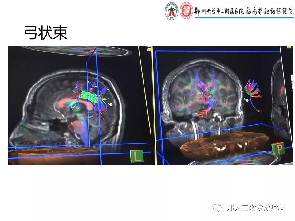 【PPT】DTI常规处理