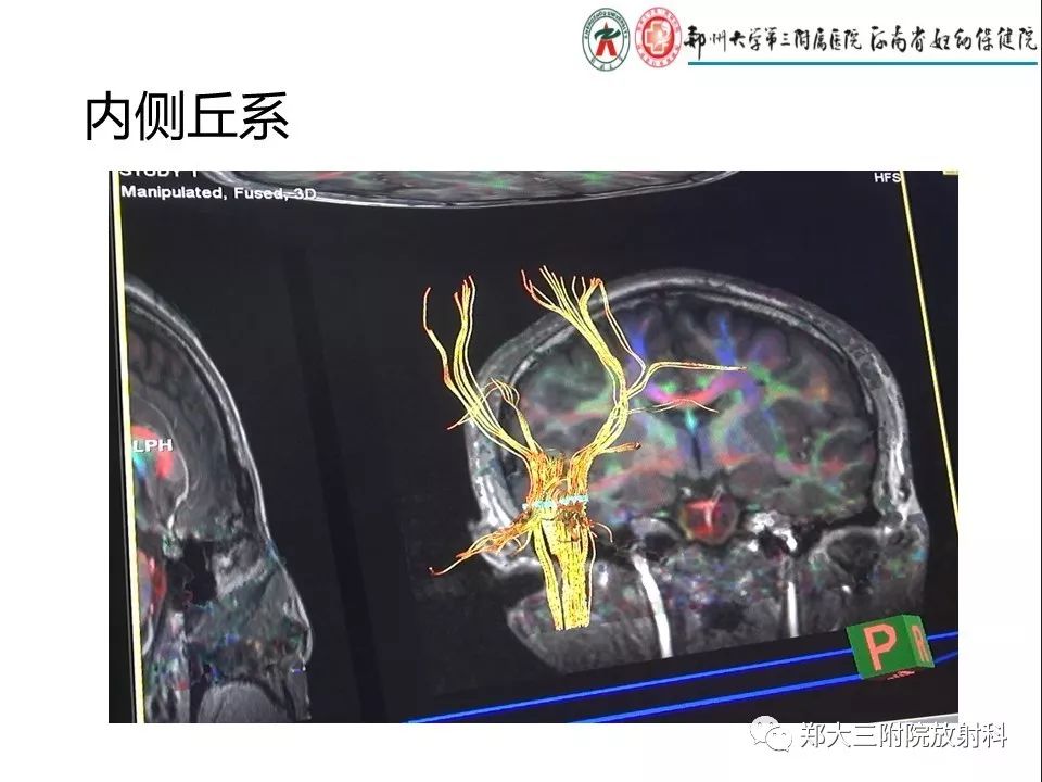 【PPT】DTI常规处理