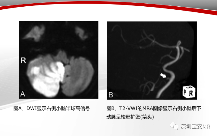 【病例】小脑后下动脉夹层1例MR