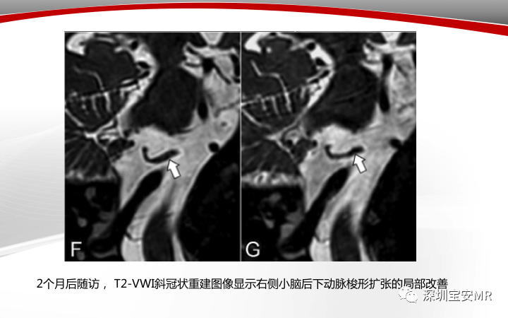 【病例】小脑后下动脉夹层1例MR