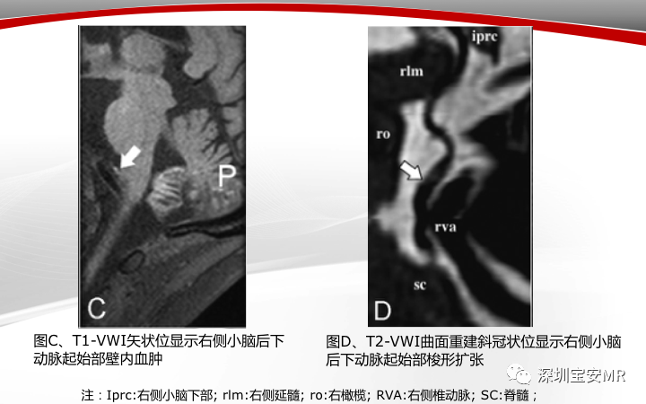【病例】小脑后下动脉夹层1例MR