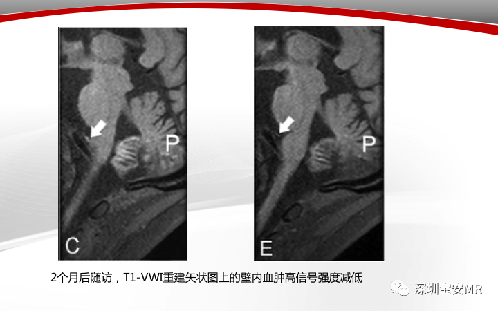 【病例】小脑后下动脉夹层1例MR