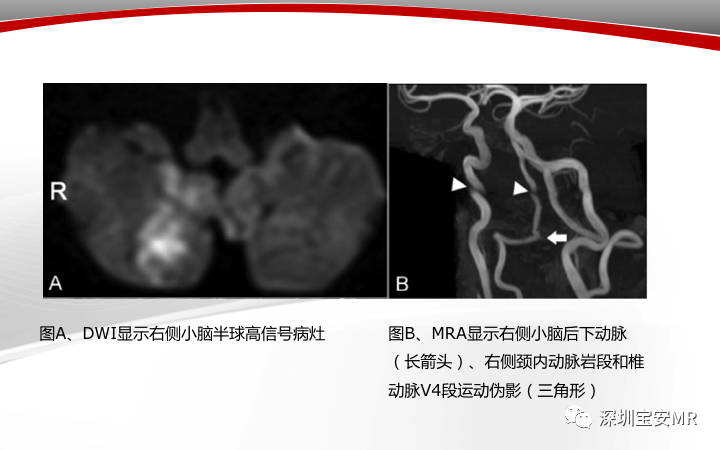 【病例】小脑后下动脉夹层1例MR