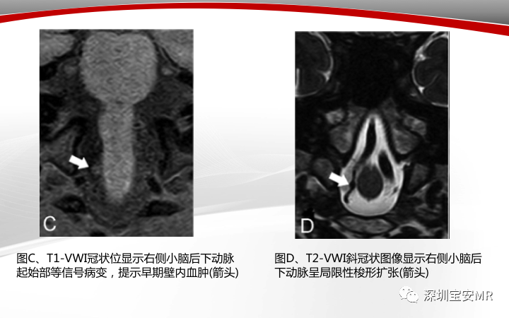 【病例】小脑后下动脉夹层1例MR