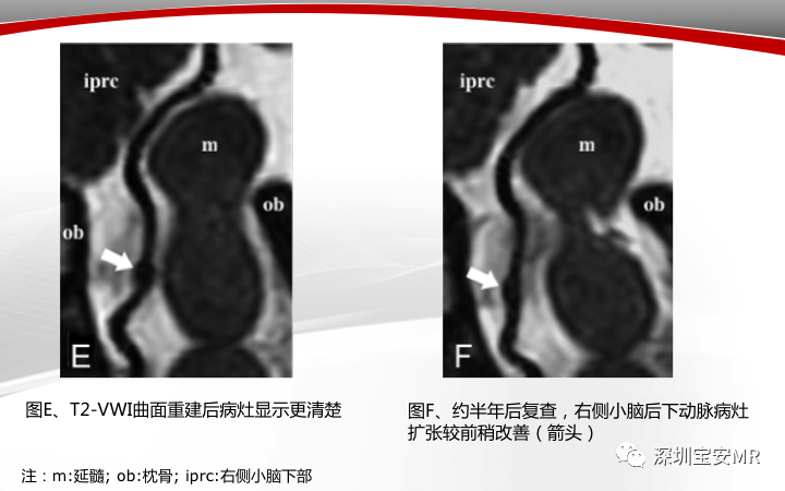 【病例】小脑后下动脉夹层1例MR