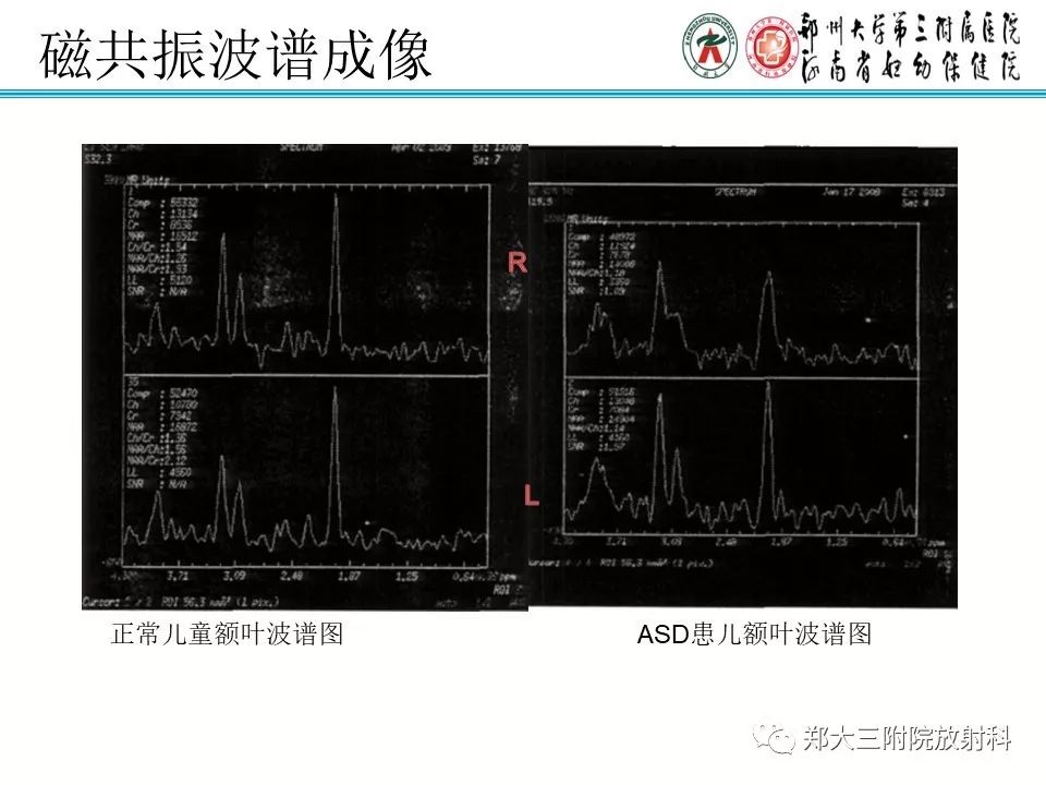 【PPT】MRI在孤独症诊疗中的应用价值