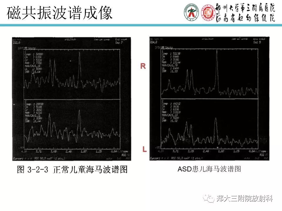 【PPT】MRI在孤独症诊疗中的应用价值
