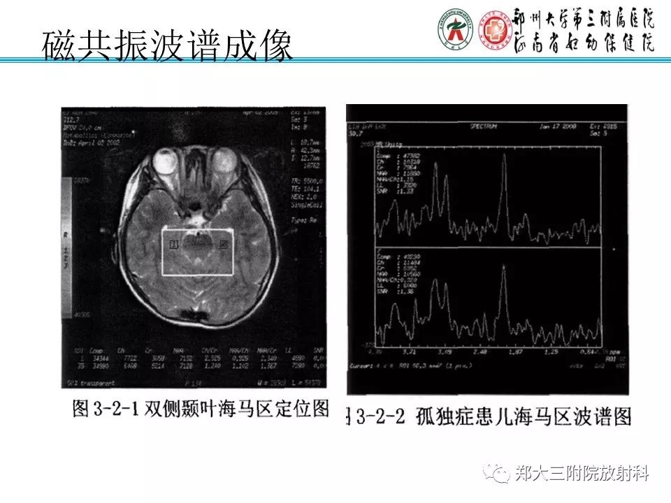 【PPT】MRI在孤独症诊疗中的应用价值