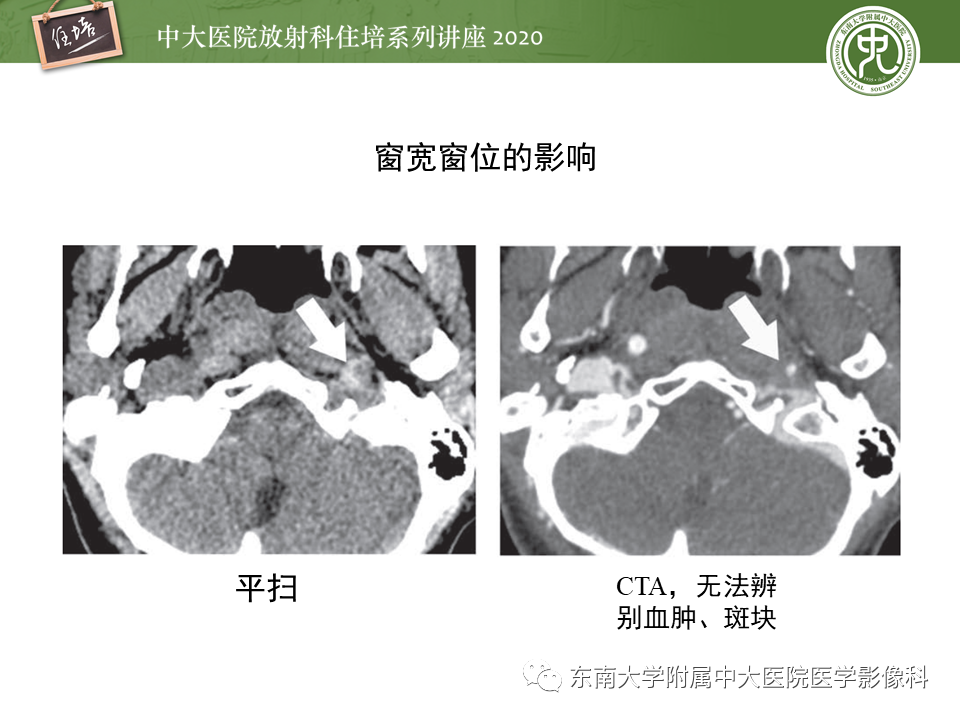 【PPT】颈动脉夹层及夹层动脉瘤的影像诊断及评估