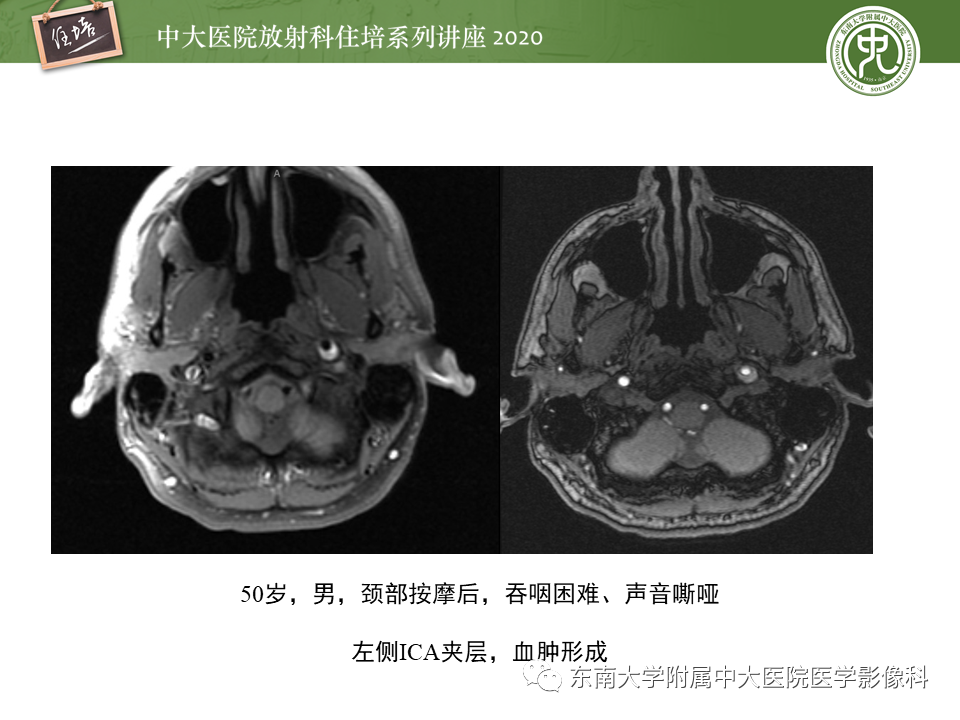 【PPT】颈动脉夹层及夹层动脉瘤的影像诊断及评估