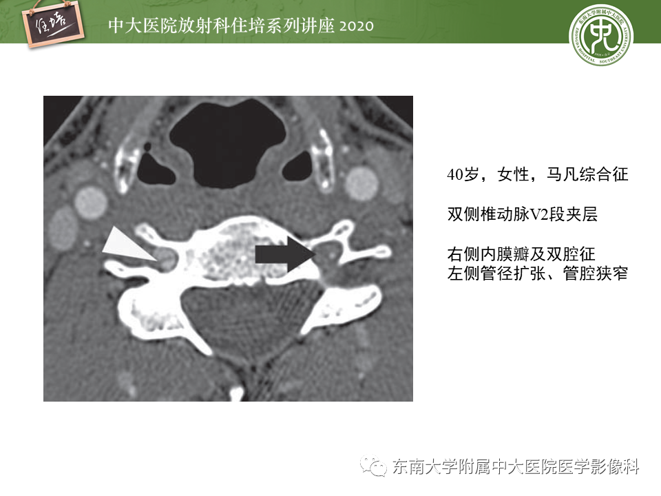 【PPT】颈动脉夹层及夹层动脉瘤的影像诊断及评估