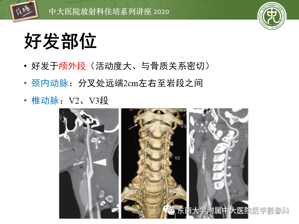 【PPT】颈动脉夹层及夹层动脉瘤的影像诊断及评估