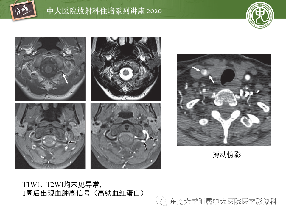 【PPT】颈动脉夹层及夹层动脉瘤的影像诊断及评估