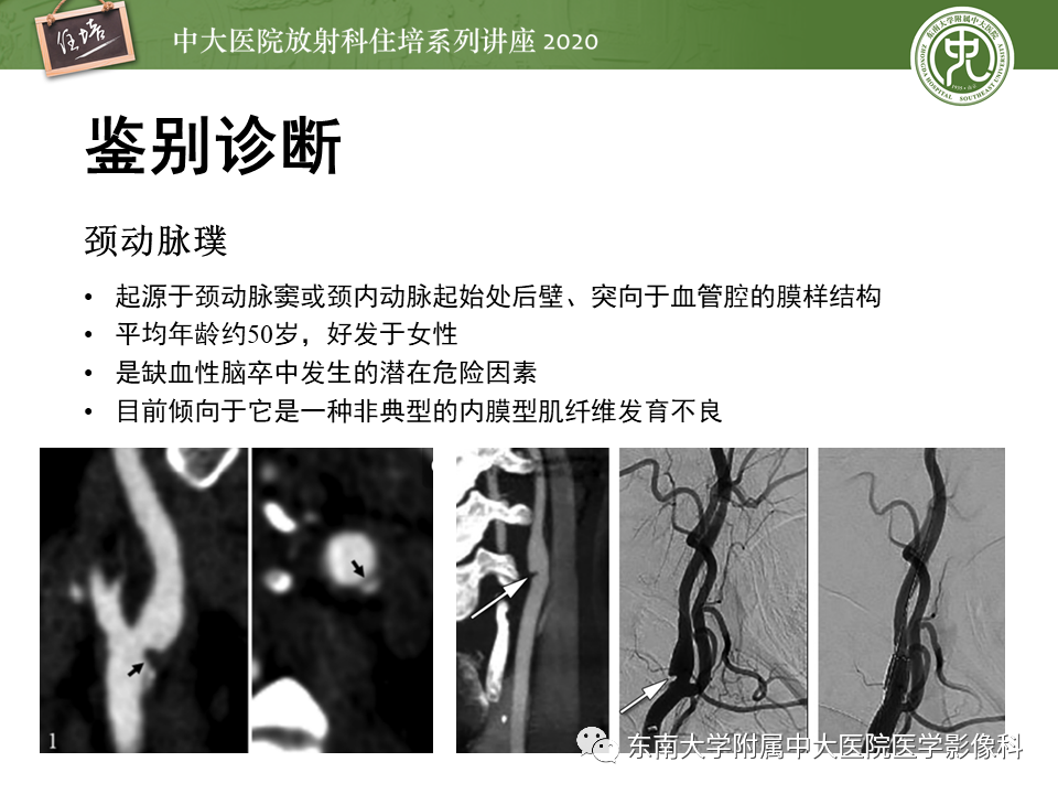【PPT】颈动脉夹层及夹层动脉瘤的影像诊断及评估