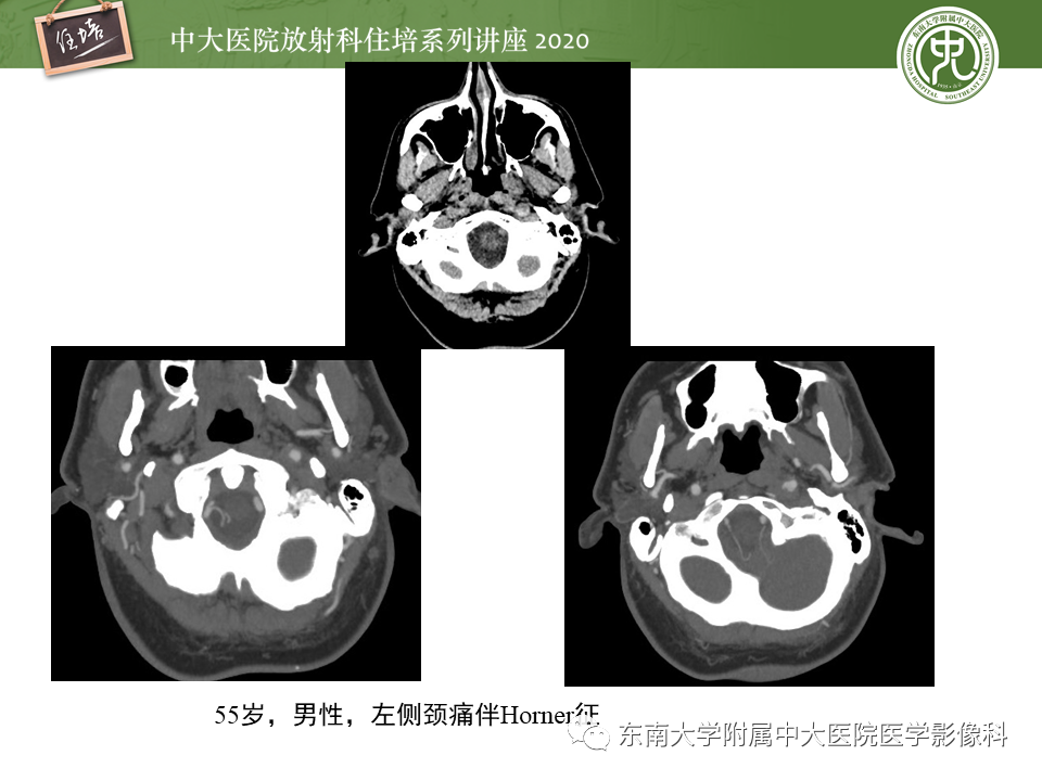 【PPT】颈动脉夹层及夹层动脉瘤的影像诊断及评估