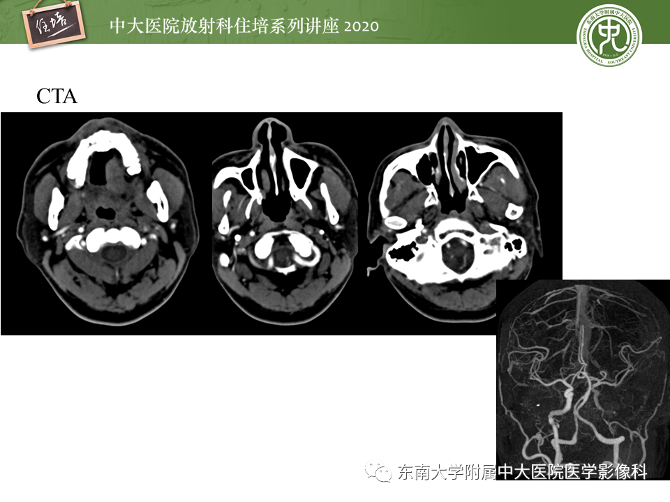 【PPT】颈动脉夹层及夹层动脉瘤的影像诊断及评估