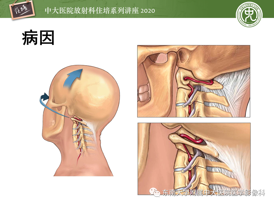 【PPT】颈动脉夹层及夹层动脉瘤的影像诊断及评估