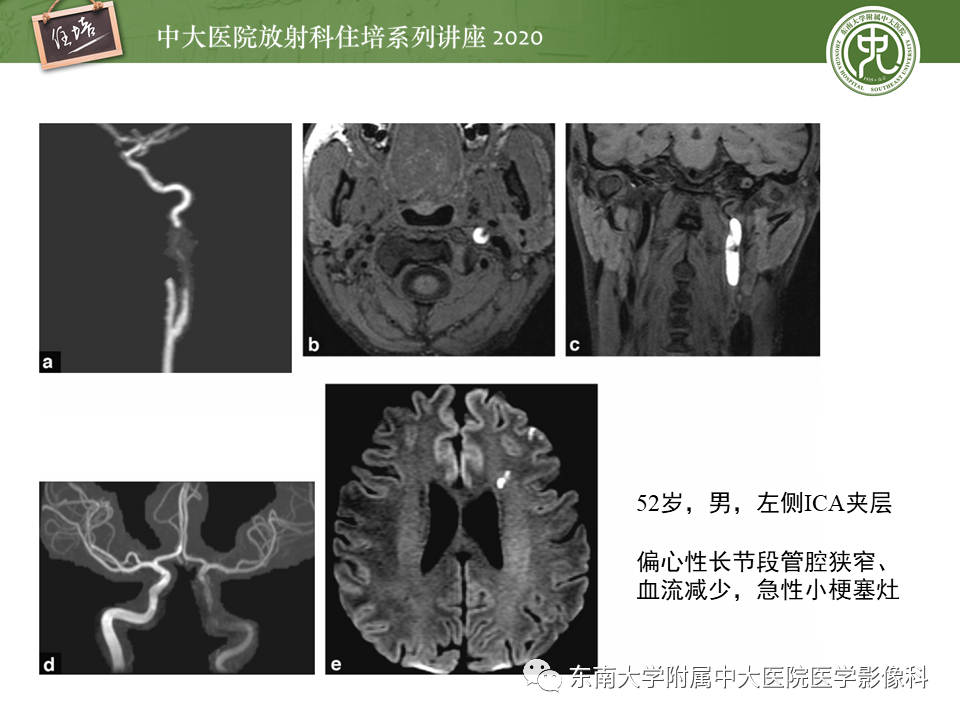 【PPT】颈动脉夹层及夹层动脉瘤的影像诊断及评估