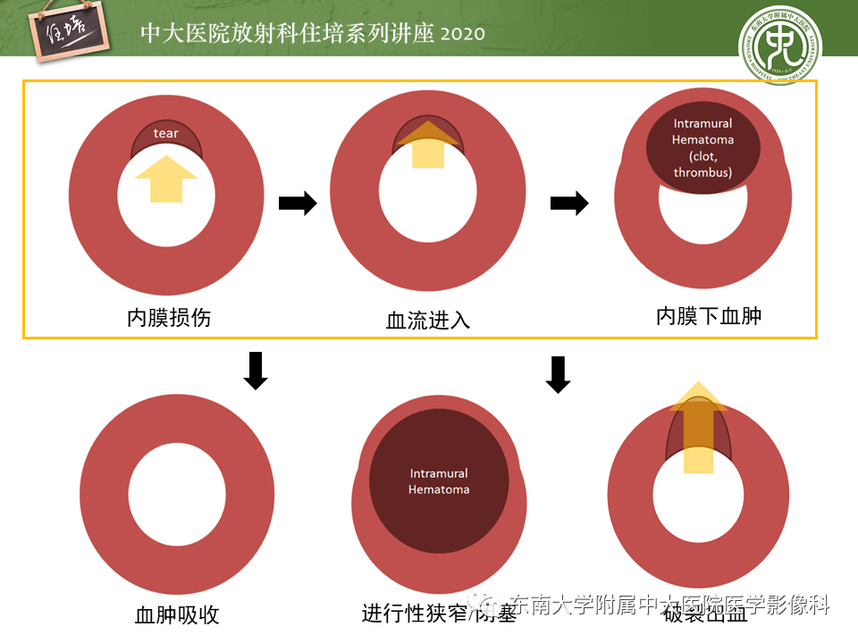 【PPT】颈动脉夹层及夹层动脉瘤的影像诊断及评估