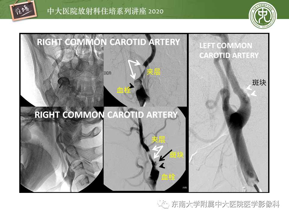 【PPT】颈动脉夹层及夹层动脉瘤的影像诊断及评估