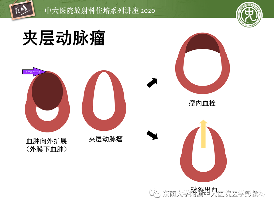 【PPT】颈动脉夹层及夹层动脉瘤的影像诊断及评估