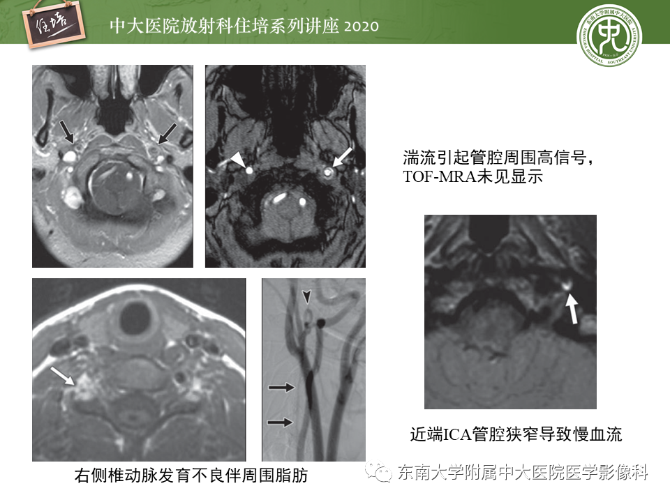 【PPT】颈动脉夹层及夹层动脉瘤的影像诊断及评估