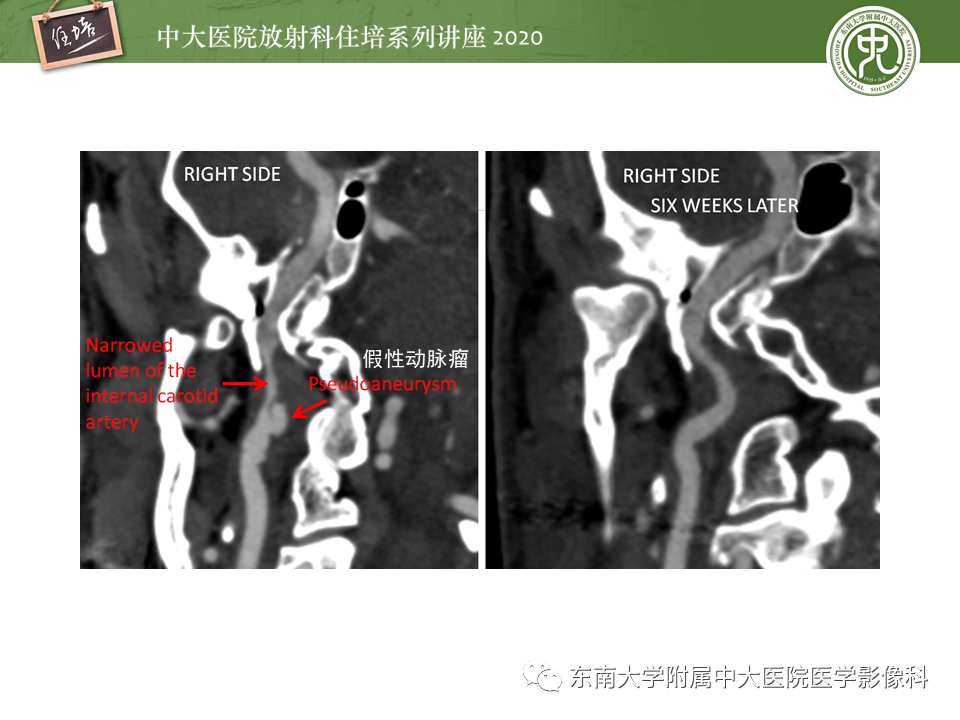 【PPT】颈动脉夹层及夹层动脉瘤的影像诊断及评估
