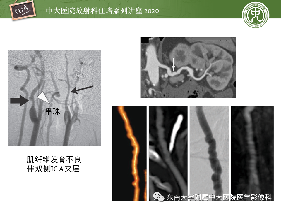 【PPT】颈动脉夹层及夹层动脉瘤的影像诊断及评估
