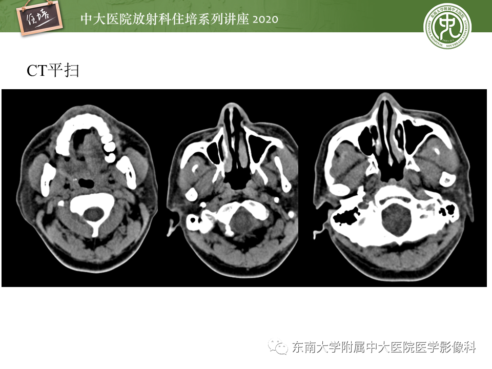 【PPT】颈动脉夹层及夹层动脉瘤的影像诊断及评估