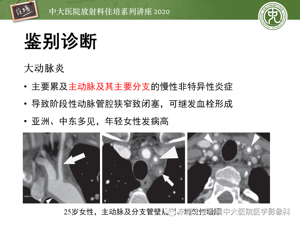 【PPT】颈动脉夹层及夹层动脉瘤的影像诊断及评估
