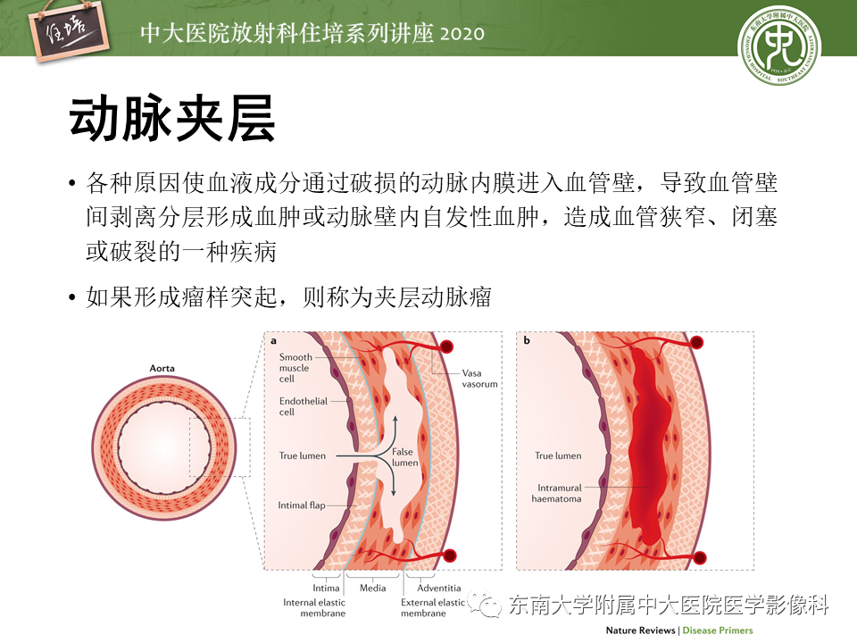 【PPT】颈动脉夹层及夹层动脉瘤的影像诊断及评估