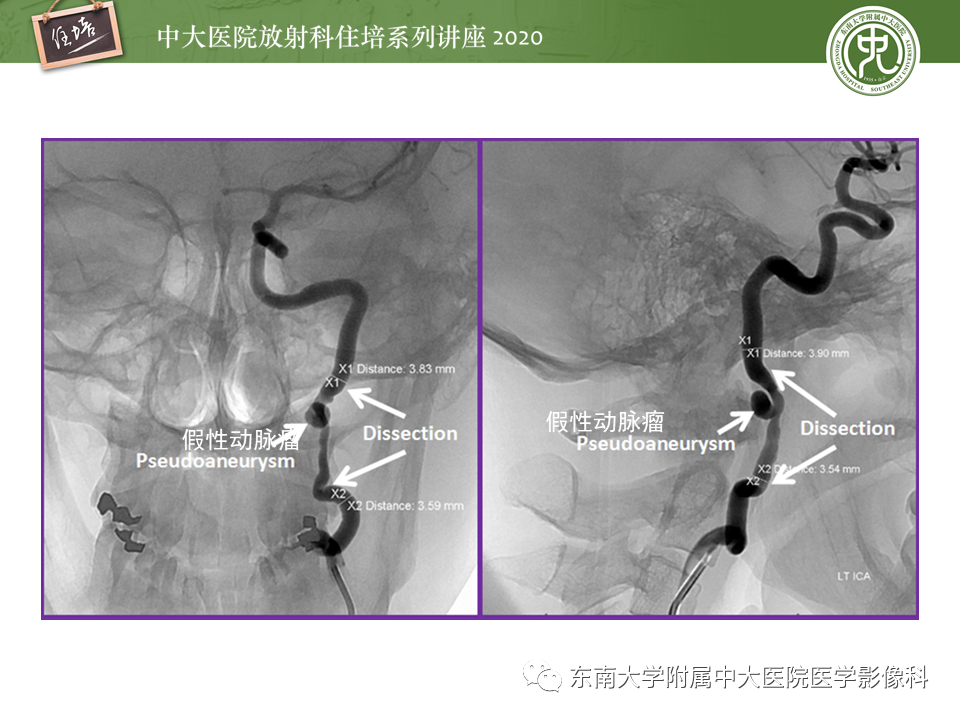 【PPT】颈动脉夹层及夹层动脉瘤的影像诊断及评估