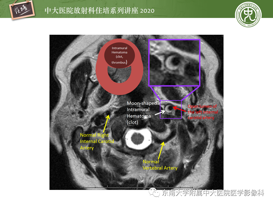 【PPT】颈动脉夹层及夹层动脉瘤的影像诊断及评估