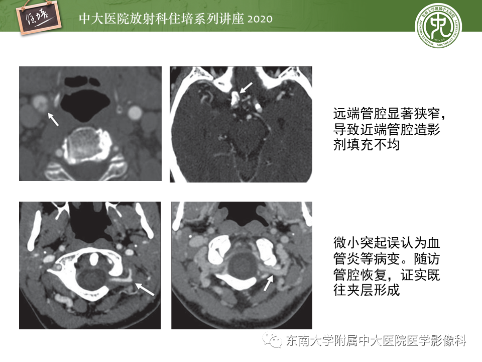 【PPT】颈动脉夹层及夹层动脉瘤的影像诊断及评估