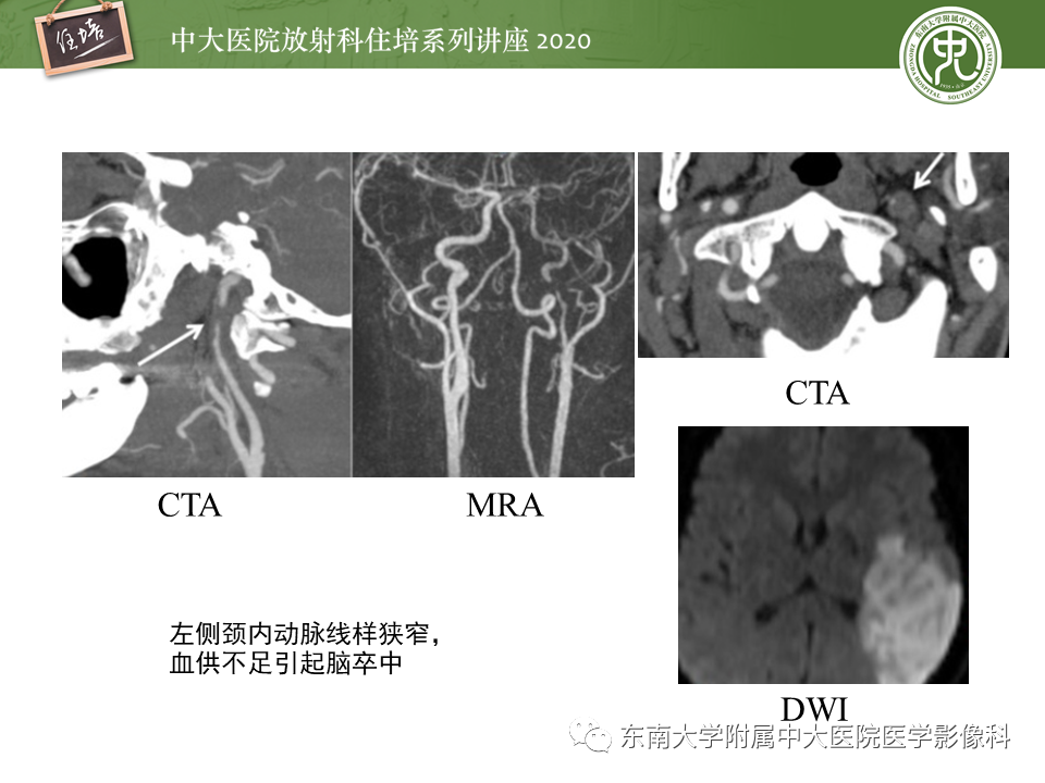 【PPT】颈动脉夹层及夹层动脉瘤的影像诊断及评估