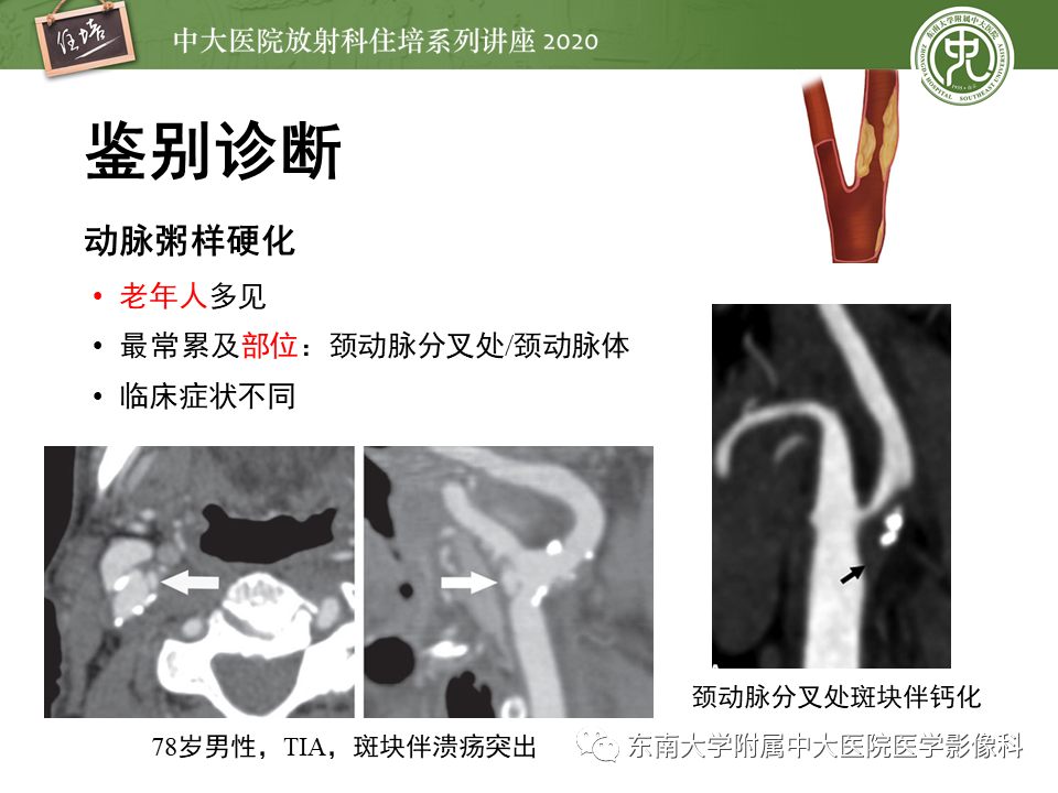 【PPT】颈动脉夹层及夹层动脉瘤的影像诊断及评估