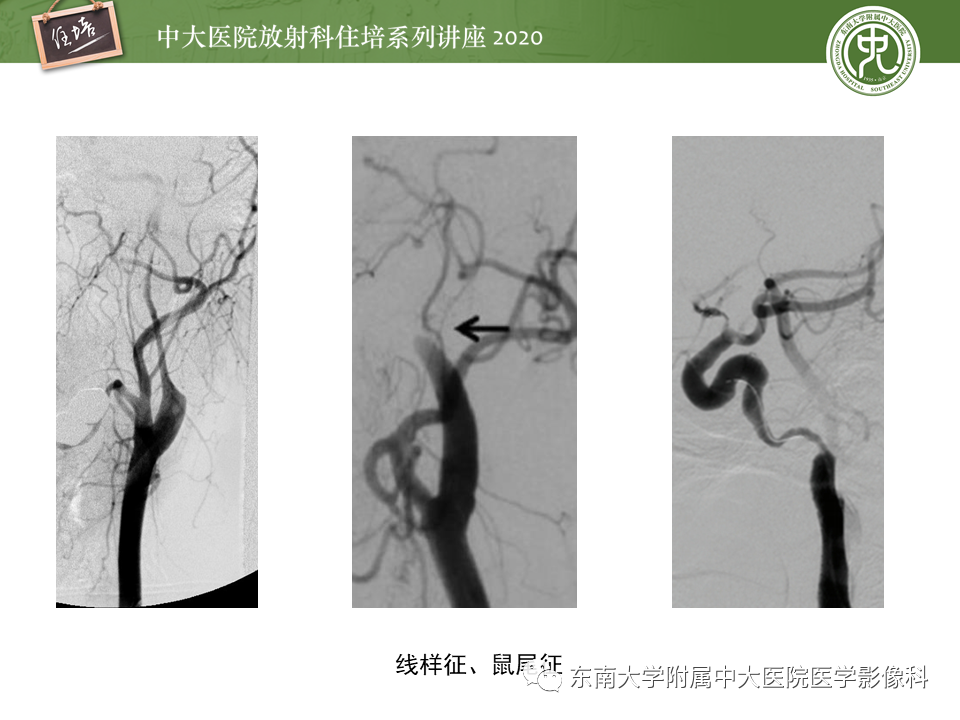 【PPT】颈动脉夹层及夹层动脉瘤的影像诊断及评估