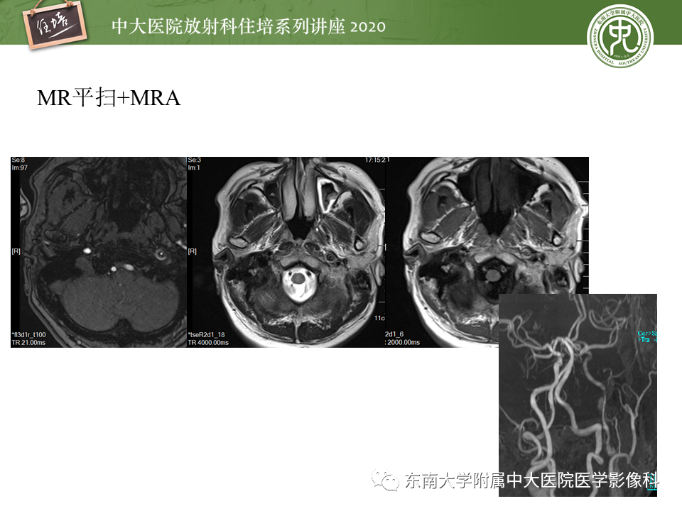 【PPT】颈动脉夹层及夹层动脉瘤的影像诊断及评估