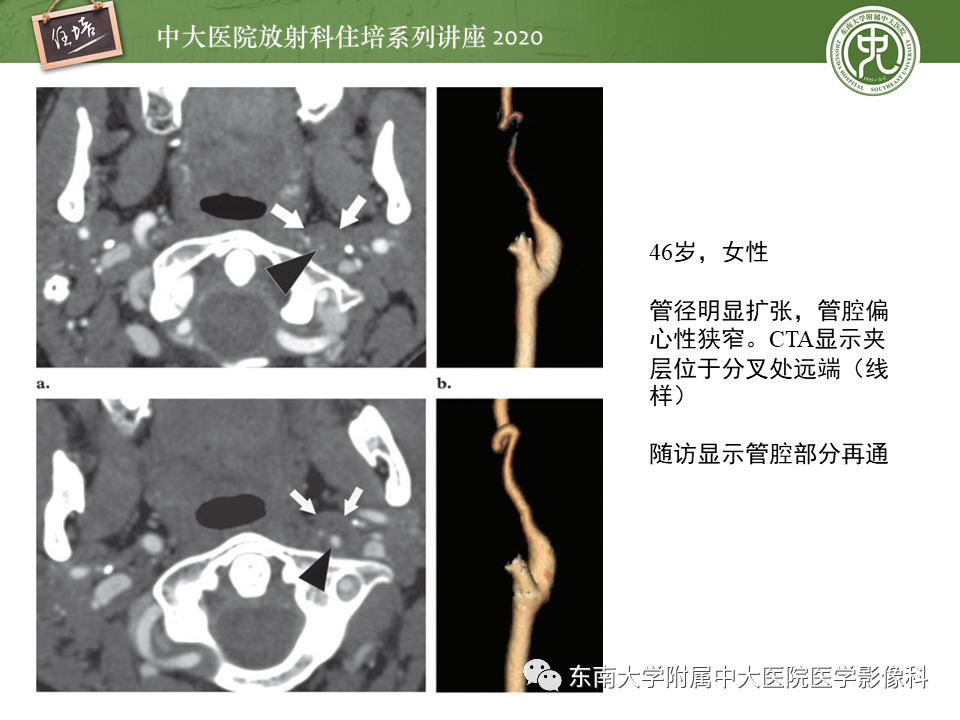 【PPT】颈动脉夹层及夹层动脉瘤的影像诊断及评估